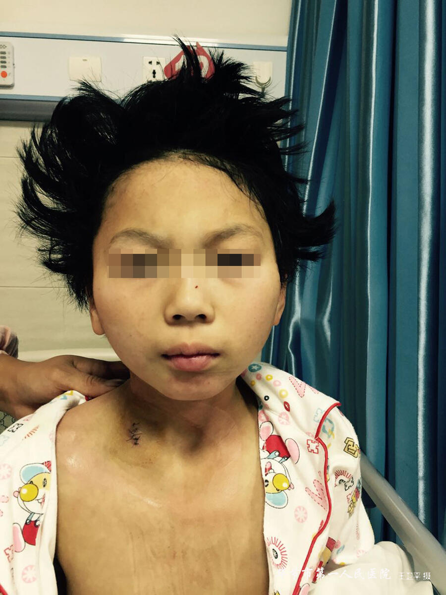 骨外科一病区为一名9岁女孩完成斜颈矫正术