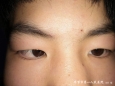 毕节市第一人民医院眼科为一名斜视患者行“右眼下斜肌断腱及部分切除术+内直肌后徙术”