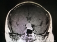 神经外科一病区成功为一名患者完成美敦力S7术中导航辅助神经内镜下经鼻蝶微创垂体大腺瘤手术