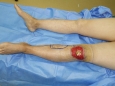 烧伤整形外科为患者行隐动脉顺行岛状皮瓣修复膝关节深度烧伤创面
