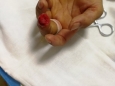 烧伤整形外科完成一例V-Y推进皮瓣修复指端缺损术
