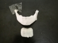口腔科应用3D数字医疗技术成功为一名患者行下颌骨颏部骨折切开复位内固定+双侧颞下颌关节复位术