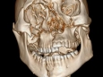 口腔科应用3D数字医疗为患者行颌面部手术