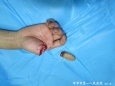 烧伤整形外科为患者行右拇指离断再植术