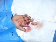 烧伤整形外科为一名患者行食指撕脱性断指再植