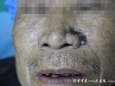 皮肤科成功为一74岁左鼻翼基底细胞癌患者行手术治疗