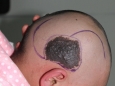 皮肤科为一4岁患儿切除头皮巨型兽皮痣