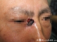 皮肤科成功手术治疗一例难治性眼角基底细胞癌