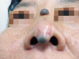皮肤科完成一例鼻尖鼻小柱肿物切除修复术