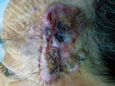 皮肤科完成一例左颞部鳞状细胞癌扩大切除术加皮瓣成形术