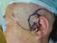 皮肤科完成一例耳前BCC切除后双旋转皮瓣修复