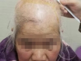 多学科协作  肿瘤“元凶”被切除近日，浙江省人民医院毕节医院烧伤整形外科一位颅顶部瘢痕癌伴颈部淋巴结转移患者，在多学科的协作下，被完整切除头部恶性肿瘤并行颈部淋巴结清扫。目前，患者恢复理想。
毕节市大方县55岁的患者李大姐，自小头皮就患皮肤病，常年长有疤痕。近年来，患者戴帽子时自觉不舒服，家属查看后发现颅顶有指姆大小的突起，没有其他不适