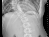 【无影灯下】重塑人生脊梁——浙毕医院顺利完成又一名青少年特发性脊椎侧凸（AIS）患者手术