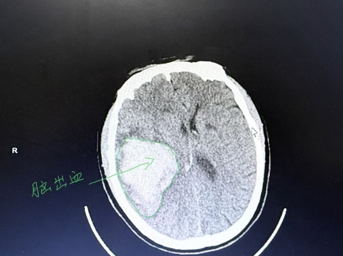 【无影灯下】一次手术 拆除两颗颅内“炸弹”